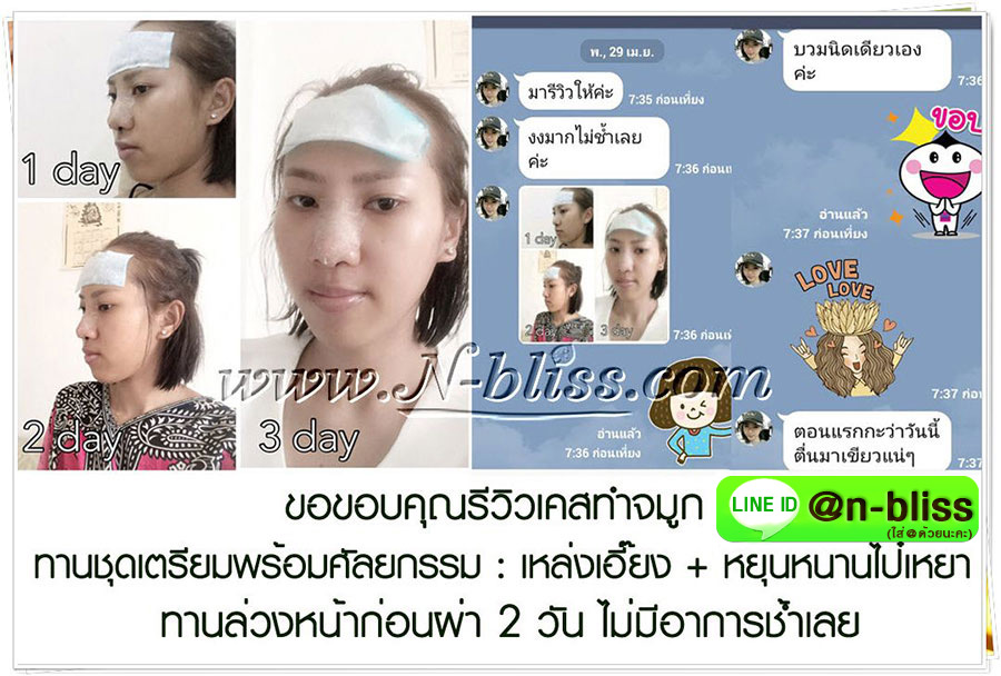 ชุดเตรียมพร้อมศัลยกรรมผ่าตัดเล็ก (หยุนหนานฯ กล่องครีมเขียว) ของแท้ 100% ร้านนี้มีเภสัชกรแผนไทยให้คำปรึกษา และได้รับทะเบียนการค้าพาณิชย์อิเล็กทรอนิกส์