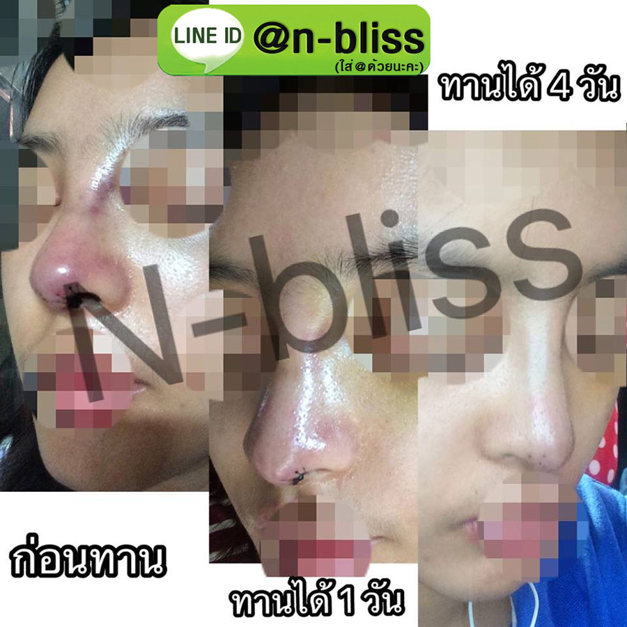 ชุดเตรียมพร้อมศัลยกรรมผ่าตัดเล็ก (หยุนหนานฯ กล่องครีมเขียว) ของแท้ 100% ร้านนี้มีเภสัชกรแผนไทยให้คำปรึกษา และได้รับทะเบียนการค้าพาณิชย์อิเล็กทรอนิกส์